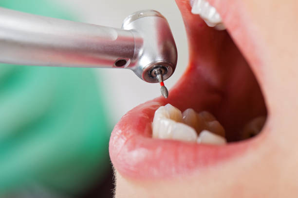 Best Emergency Dentist for Lost Fillings or Crowns in Marbleton, WY